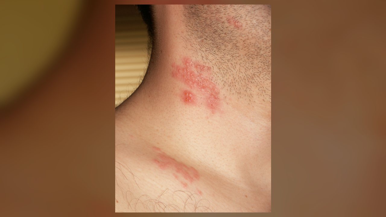 Cinco remédios caseiros ajudam a aliviar sintomas do herpes zóster